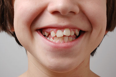 A smiling child demonstrating impacted canines