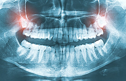 X-ray image of wisdom teeth at Surprise Oral & Implant Surgery.