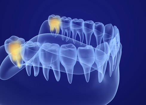 Rendered image of wisdom teeth from Surprise Oral & Implant Surgery in Surprise, AZ