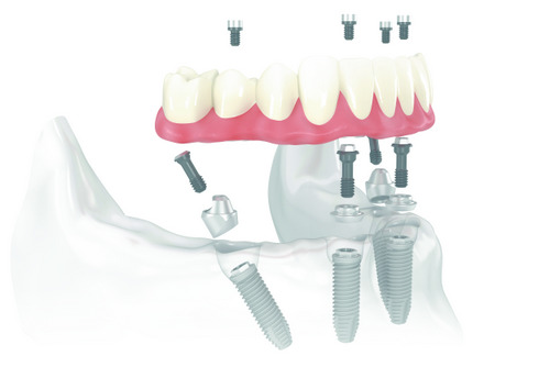 Should You Get All-On-4 Dentures?