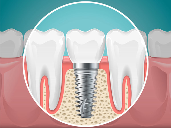 Diagram of a tooth replaced with a dental implant