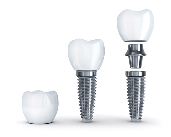 Diagram of dental implant with post