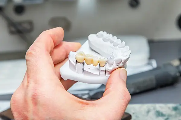 Hand holding a dental model with a fixed dental bridge, showcasing realistic tooth restoration.