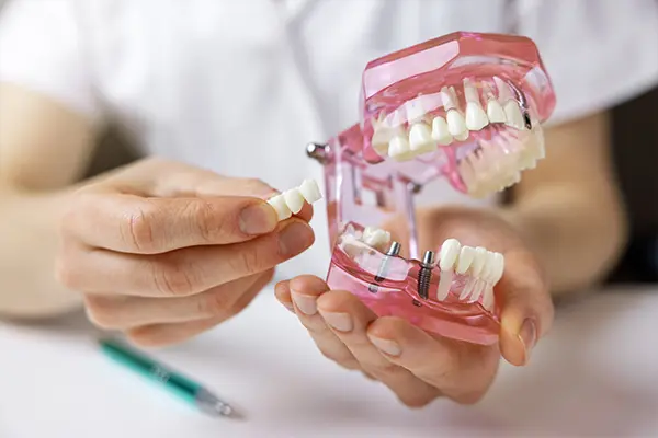 A dentist holding a dental implant model with a pink jaw replica, demonstrating how implants restore missing teeth.