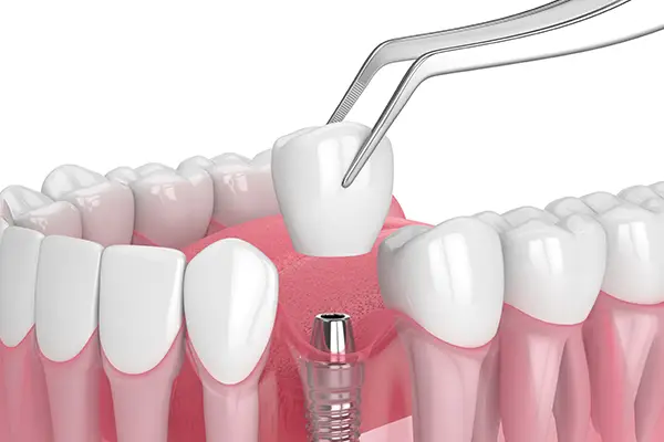 Close-up of a dental implant with crown being placed on the implant illustrated by Surprise Oral & Implant Surgery in Surprise, AZ