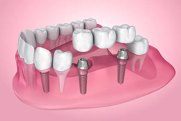 A diagram showing how a dental bridge is supported by two implants illustrated by Surprise Oral & Implant Surgery in Surprise, AZ
