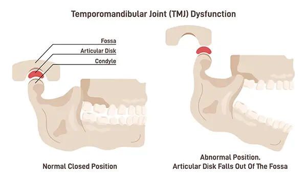 A medical diagram showing the difference between a normal temporomandibular joint (TMJ) position and an abnormal position causing TMJ dysfunction.